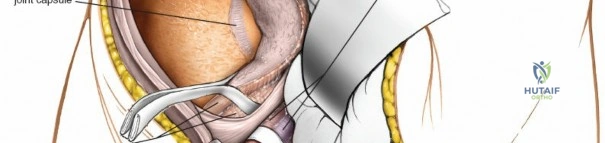 علاج انزياح وتر العضلة ذات الرأسين العضدية دليلك الطبي الشامل