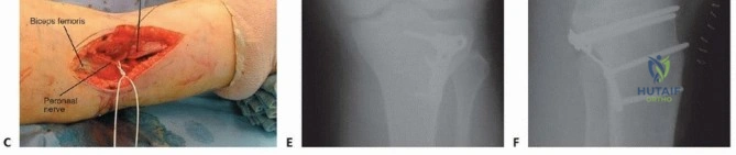 صورة توضيحية لـ علاج تصلب المرفق: دليلك الشامل لاستعادة حركة ذراعك الطبيعية