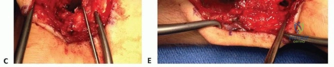 صورة توضيحية لـ التصاق الأصابع (الأصابع الوتراء): دليل شامل للمرضى والعائلات في اليمن والخليج العربي