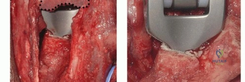 صورة توضيحية لـ التهاب اللفافة الأخمصية المزمن المصحوب بمتلازمة النفق الرسغي: دليل شامل للمرضى