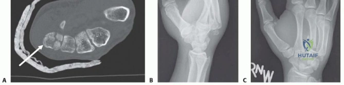 صورة توضيحية لـ إصابات مفصل الترقوة والكتف (المفصل الأخرمي الترقوي): دليل شامل للمرضى مع الأستاذ الدكتور محمد هطيف
