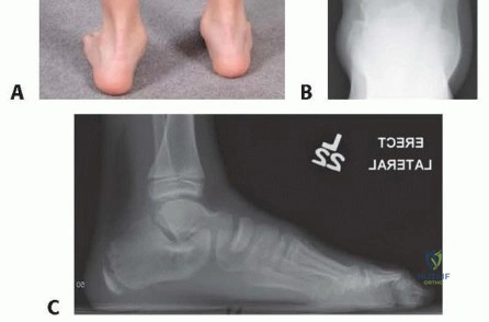صورة توضيحية لـ كسور الكابيتلوم والبكرة العضدية: دليل شامل للمرضى نحو التعافي الكامل مع الدكتور محمد هطيف