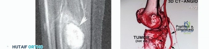 صورة توضيحية لـ استئصال ورم العضلة النعلية: دليل شامل لحماية عضلة الساق والتعافي الكامل في صنعاء مع الأستاذ الدكتور محمد هطيف