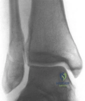 صورة توضيحية لـ كسور عظم العضد القريب: دليل المرضى الشامل لاستعادة حركة الكتف والحياة الطبيعية