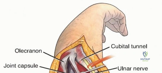 الدليل الشامل لعملية إصلاح تمزق الغضروف المثلثي المفتوحة في المعصم