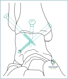 صورة توضيحية لـ جراحات القدم والكاحل المتقدمة: دليلك الشامل مع الأستاذ الدكتور محمد هطيف في صنعاء