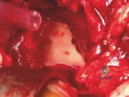 صورة توضيحية لـ إعادة تسطيح مفصل الورك بالنخر العظمي للمرضى الشباب والنشطين خبرة الأستاذ الدكتور محمد هطيف في صنعاء