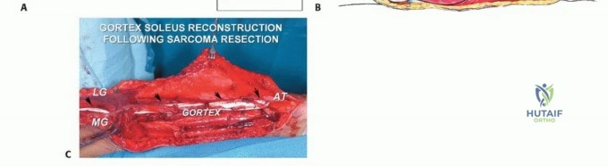 صورة طبية: استئصال ورم العضلة النعلية: دليل شامل لحماية عضلة الساق والتعافي الكامل في صنعاء مع الأستاذ الدكتور محمد هطيف