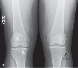 صورة توضيحية لـ إصابات الملاعب والطب الرياضي: دليل شامل للتشخيص والعلاج مع الأستاذ الدكتور محمد هطيف في صنعاء