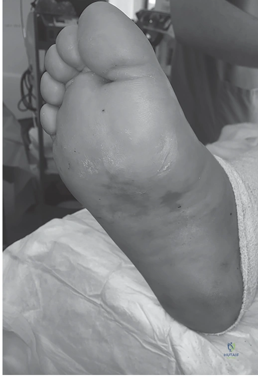 Illustration of case lisfranc injury - Dr. Mohammed Hutaif