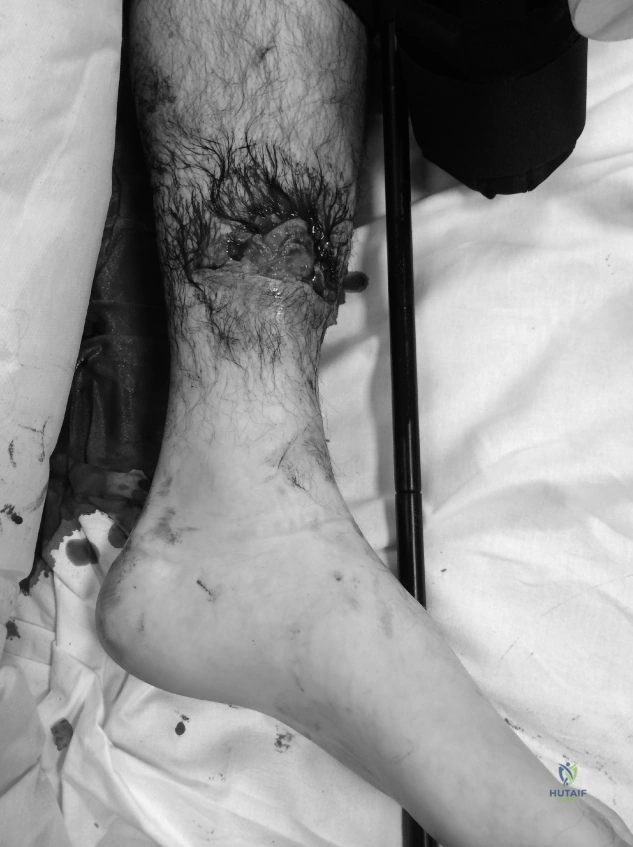 صورة توضيحية لـ كسور قصبة الساق عالية الطاقة: دليل شامل للمرضى من الأستاذ الدكتور محمد هطيف في صنعاء
