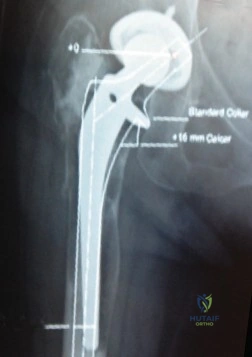 صورة توضيحية لآلية تآكل مفصل الورك