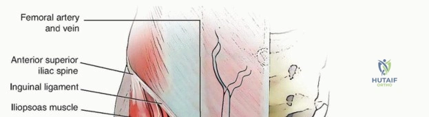 صورة توضيحية لـ استبدال مفصل الورك الكلي: رحلة آمنة لتجنب المضاعفات مع الأستاذ الدكتور محمد هطيف