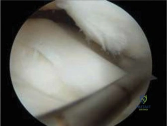 صورة توضيحية لـ كسر صفيحة النمو المعقد في كاحل الأطفال: دليل شامل للعلاج والتعافي مع الأستاذ الدكتور محمد هطيف