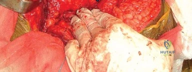 صورة طبية: إتقان توازن الأنسجة الرخوة لمفصل ورك صناعي مثالي: دليل شامل للمرضى مع الأستاذ الدكتور محمد هطيف