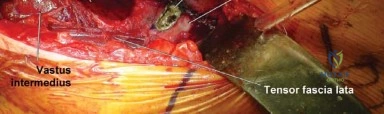 إغلاق الجرح بطريقة تجميلية دقيقة