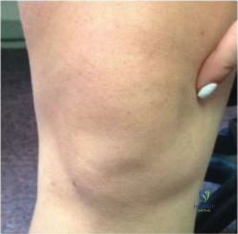 صورة توضيحية لـ ألم الركبة الأمامي عند الأطفال: دليل شامل للتشخيص والعلاج الفعال مع الأستاذ الدكتور محمد هطيف