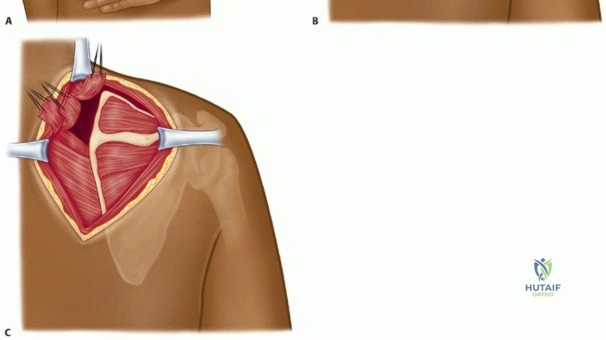 صورة طبية: متلازمة لوح الكتف الطقطقة الأسباب الأعراض والعلاج مع الأستاذ الدكتور محمد هطيف