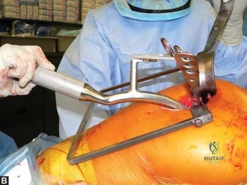 صورة طبية: استبدال مفصل الورك الكلي في العيادات الخارجية: دليل شامل من الأستاذ الدكتور محمد هطيف في صنعاء