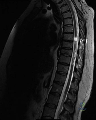 Mastering Hemivertebra Unilateral Bar Diagnosis: 12 Cases