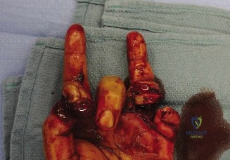 صورة توضيحية لـ إصابة العصب الكعبري السطحي: دليل شامل للتشخيص والعلاج مع الأستاذ الدكتور محمد هطيف في صنعاء