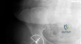 صورة توضيحية لـ جراحة استبدال مفصل الورك بالمدخل الأمامي المباشر بدون طاولة شد: دليل شامل للمرضى في صنعاء