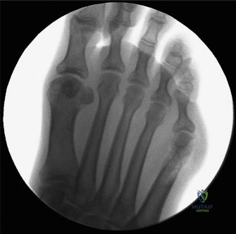 Bunionette Deformity: Epidemiology, Surgical Anatomy, Biomechanics & Management