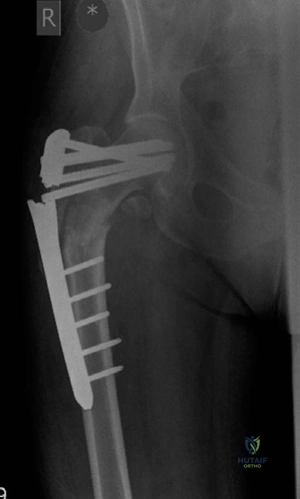 Illustration 7 for Lower Limb Trauma: Decipher Anteroposterior (AP) Figure for Exams