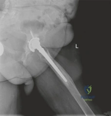 صورة توضيحية لـ جراحة مراجعة مفصل الورك المعقدة وزراعة العظام بالضغط: حلول متقدمة لتعويض مفصل الورك الفاشل