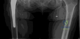 صورة توضيحية لـ جراحة مفصل الورك المراجع وزراعة العظم الحوضي: حلول متقدمة لآلام الورك المزمنة