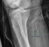 صورة توضيحية لـ كسر قصبة الساق الممتد إلى مفصل الكاحل (البلافون): أسرار العلاج بالمسمار النخاعي مع الأستاذ الدكتور محمد هطيف