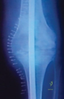 صورة طبية: تثبيت مفصل الركبة بالمسمار النخاعي: حل فعال لمشاكل المفاصل الصناعية الفاشلة