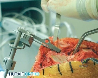 صورة طبية: جراحة استبدال المفاصل بدون أسمنت: دليل شامل للمرضى مع الأستاذ الدكتور محمد هطيف في صنعاء