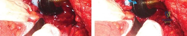 صورة طبية: إتقان توازن الأنسجة الرخوة لمفصل ورك صناعي مثالي: دليل شامل للمرضى مع الأستاذ الدكتور محمد هطيف