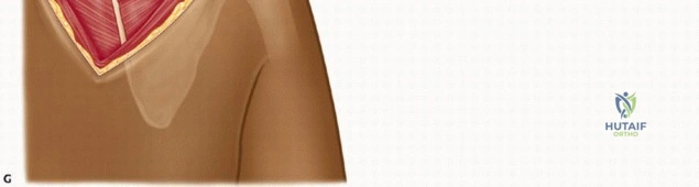 صورة طبية: متلازمة لوح الكتف الطقطقة الأسباب الأعراض والعلاج مع الأستاذ الدكتور محمد هطيف