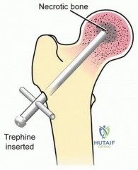 Illustration 1 for Head-Sparing for Osteonecrosis of the Femoral: Preserve Your Hip