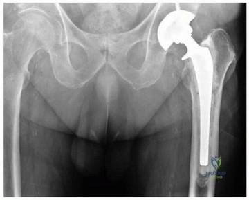 صورة طبية: إتقان مراجعة استبدال مفصل الورك: استراتيجيات تحديات الأنسجة المحلية الضارة