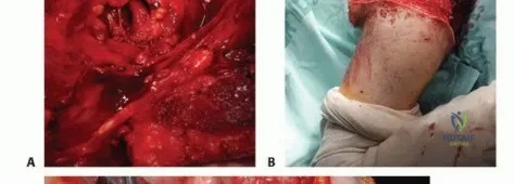صورة توضيحية لـ بتر الربع الأمامي: كل ما يجب أن تعرفه عن هذا الإجراء المعقد