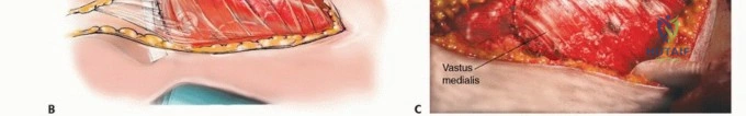 صورة طبية: النقائل العظمية الفخذية: دليل شامل للعلاج واستعادة الوظيفة مع الأستاذ الدكتور محمد هطيف في صنعاء
