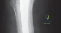 صورة توضيحية لـ استبدال مفصل الورك بجذع الفخذ الإسمنتي: دليل شامل للمرضى مع الأستاذ الدكتور محمد هطيف