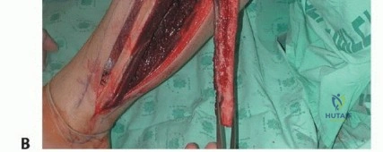 صورة طبية: ترقيع الشظية الوعائي الحر: حلول متقدمة لعيوب العظام المعقدة