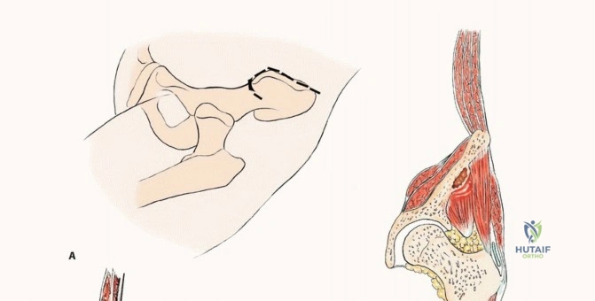 استخدام التقنيات الحديثة في تنظيف الورم
