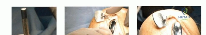 صورة طبية: استبدال مفصل الركبة الجزئي: حل متقدم لآلام الركبة المستمرة مع الأستاذ الدكتور محمد هطيف