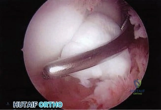 صورة طبية: دليلك الشامل لآلام ومشاكل الكتف والمرفق: التشخيص والعلاج مع الأستاذ الدكتور محمد هطيف في صنعاء
