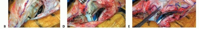 صورة طبية: تصلب مفصل الركبة بعد جراحة المراجعة: الأسباب، التشخيص، والعلاج الأمثل مع الأستاذ الدكتور محمد هطيف في صنعاء