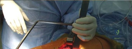 صورة طبية: استبدال مفصل الورك الكلي الناجح في خلل التنسج النمائي للورك: دليل شامل من الأستاذ الدكتور محمد هطيف