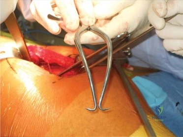 صورة طبية: استبدال مفصل الورك الكلي الناجح في خلل التنسج النمائي للورك: دليل شامل من الأستاذ الدكتور محمد هطيف