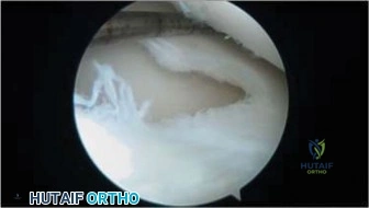 صورة طبية: التهاب العظم والغضروف السالخ وإصابات الركبة الأخرى لدى الأطفال: دليل شامل للآباء