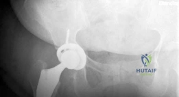 صورة توضيحية لـ جراحة استبدال مفصل الورك بالمدخل الأمامي المباشر بدون طاولة شد: دليل شامل للمرضى في صنعاء