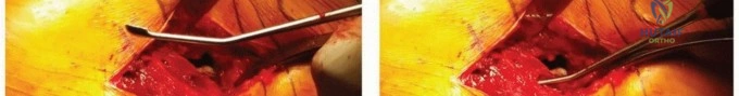 صورة طبية: ساق الفخذ المدبب: دليل شامل لتثبيت مفصل الورك اللاأسمنتي طويل الأمد مع الأستاذ الدكتور محمد هطيف في صنعاء